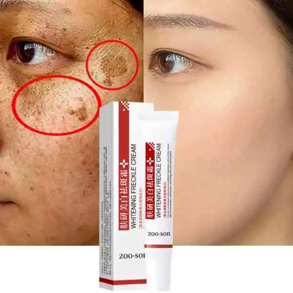 WHITENING FRECKLE CREAM